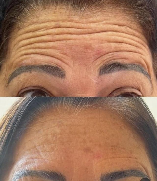 Testa antes e depois da aplicação de botox, com as rugas de expressão suavizadas