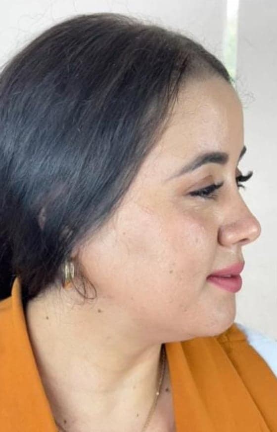 Paciente de perfil após harmonização facial
