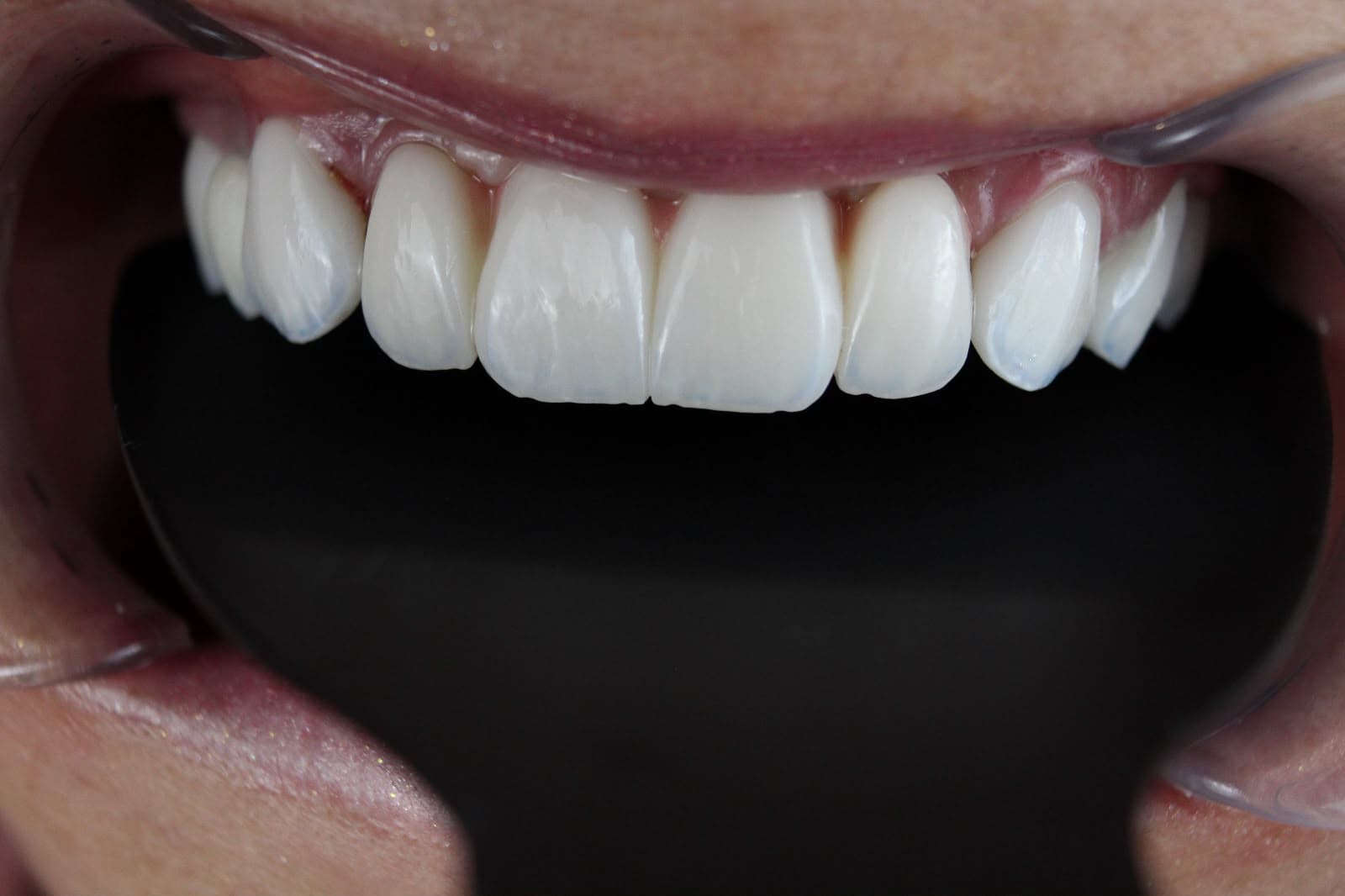 Close-up de dentes superiores restaurados com lentes de contato dental e implantes em porcelana